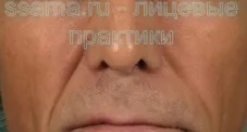 Спазми і гіпертонус м'язів обличчя - зможу сама (нерівності) Спазми і гіпертонус м'язів обличчя - зможу сама
