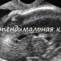 Стеноз судин головного мозку, симптоми і лікування (лікування) Стеноз судин головного мозку, симптоми і лікування