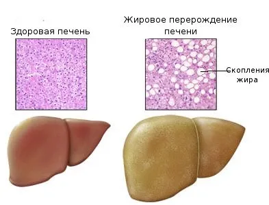 Стеатоз печінки що це таке, лікування, препарати, симптоми (печінки) Стеатоз печінки що це таке, лікування, препарати, симптоми