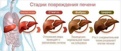 Стеатоз печінки що це таке, лікування, препарати, симптоми (печінки) Стеатоз печінки що це таке, лікування, препарати, симптоми