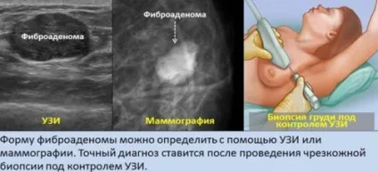 Що таке фіброзно кістозна мастопатія і чим вона небезпечна (мастопатія) Що таке фіброзно кістозна мастопатія і чим вона небезпечна