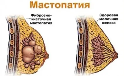 Що таке фіброзно кістозна мастопатія і чим вона небезпечна (таке) Що таке фіброзно кістозна мастопатія і чим вона небезпечна