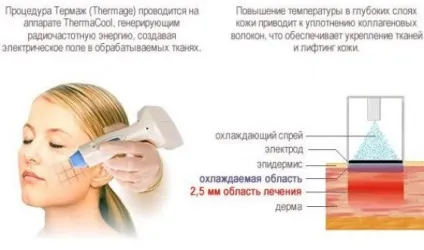 Термаж особи-суть, плюси, мінуси, хід процедури thermage (термаж особи суть плюси мінуси хід процедури thermage переваги недоліки сеанс в домашніх умовах показання протипоказання фото відео інструкції) Термаж особи-суть, плюси, мінуси, хід процедури thermage