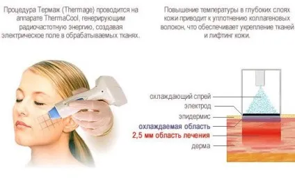 Термаж особи-суть, плюси, мінуси, хід процедури thermage (термаж) Термаж особи-суть, плюси, мінуси, хід процедури thermage