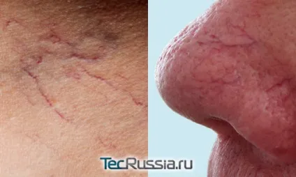 Видалення судин на обличчі і на ногах лазером - фото, наслідки, відгуки і ціни (можна) Видалення судин на обличчі і на ногах лазером - фото, наслідки, відгуки і ціни