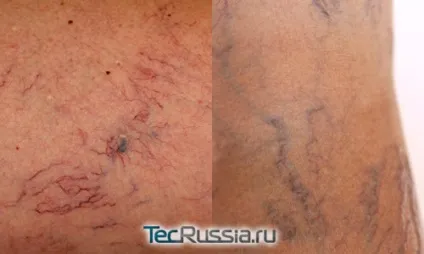 Видалення судин на обличчі і на ногах лазером - фото, наслідки, відгуки і ціни (лазера) Видалення судин на обличчі і на ногах лазером - фото, наслідки, відгуки і ціни