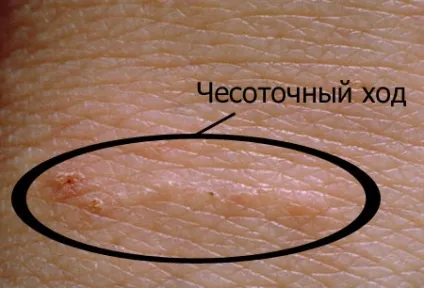 У дитини свербіж в інтимній зоні (інтимній зоні дитини) У дитини свербіж в інтимній зоні
