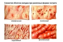 види гастриту