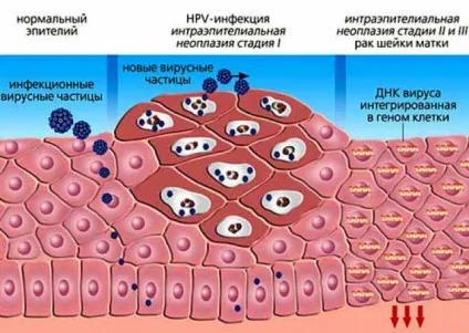 ВПЛ 16, 18 типів основні принципи лікування, медикаментозна та інвазивна терапія, народні методи (народні) ВПЛ 16, 18 типів основні принципи лікування, медикаментозна та інвазивна терапія, народні методи