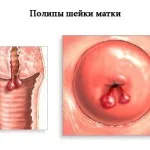 Злоякісна і доброякісна пухлина матки симптоми і лікування