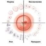 Злоякісна і доброякісна пухлина матки симптоми і лікування