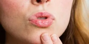 Закупорка слинної залози симптоми, лікування, наслідки, профілактика сіалоліта (лікування) Закупорка слинної залози симптоми, лікування, наслідки, профілактика сіалоліта