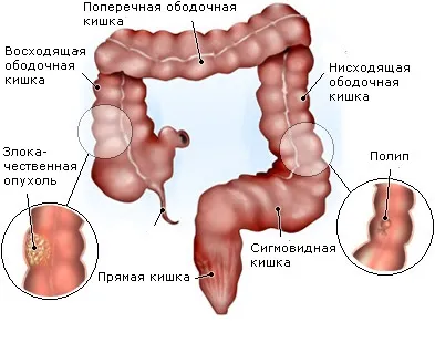 Аденокарцинома сигмовидної кишки прогноз, лікування