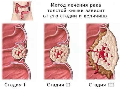 Аденокарцинома сигмовидної кишки прогноз, лікування