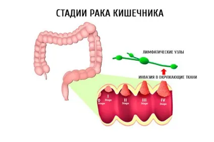 Аденокарцинома сигмовидної кишки, симптоми і лікування аденокарциноми сигмовидної кишки, компетентно (аденокарцинома сигмовидної кишки) Аденокарцинома сигмовидної кишки, симптоми і лікування аденокарциноми сигмовидної кишки, компетентно