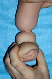 амниотические перетяжки