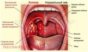 Ангіна ефективні народні методи і засоби лікування ангіни (ангіна) Ангіна ефективні народні методи і засоби лікування ангіни
