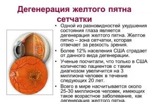 Атрофія сітківки, як наслідок дистрофії (дистрофії) Атрофія сітківки, як наслідок дистрофії