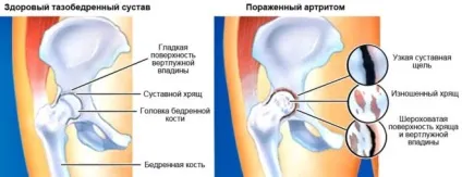 Артрит кульшового суглоба у дітей (артрит тазостегнового суглоба) Артрит кульшового суглоба у дітей