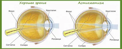 Астигматизм причини, симптоми і лікування захворювання (симптоми) Астигматизм причини, симптоми і лікування захворювання