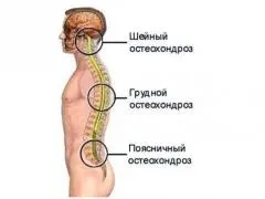 Як вилікувати хондроз в домашніх умовах, ліки, гімнастика, народна медицина (умовах) Як вилікувати хондроз в домашніх умовах, ліки, гімнастика, народна медицина