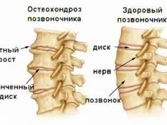 Як вилікувати хондроз в домашніх умовах, ліки, гімнастика, народна медицина (здоров'я) Як вилікувати хондроз в домашніх умовах, ліки, гімнастика, народна медицина