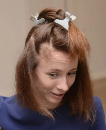 Як вилікувати залисини в області чола і скронь зачіски, які приховують алопецію у жінок (області) Як вилікувати залисини в області чола і скронь зачіски, які приховують алопецію у жінок