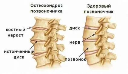 Як вилікувати хондроз в домашніх умовах, ліки, гімнастика, народна медицина (умовах) Як вилікувати хондроз в домашніх умовах, ліки, гімнастика, народна медицина