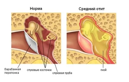 Як відновити слух після отиту, лікування зниження слуху (лікування) Як відновити слух після отиту, лікування зниження слуху