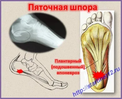 Як вилікувати п'яткову шпору традиційними методами (методами) Як вилікувати п'яткову шпору традиційними методами