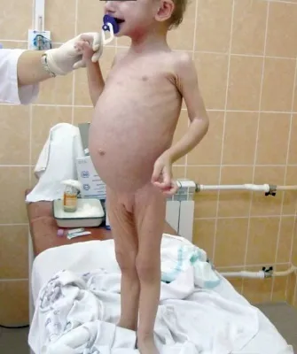 Хвороба целіакія у дітей фото, харчування та вітаміни при целіакії