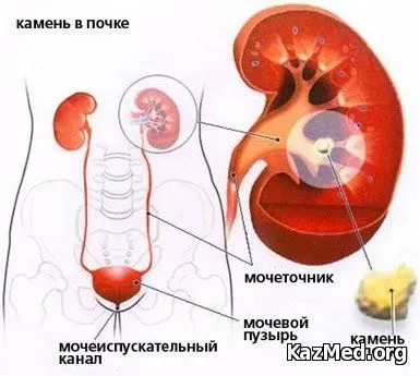 Хвороби нирок і сечовивідних шляхів симптоми (хвороби) Хвороби нирок і сечовивідних шляхів симптоми