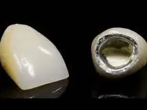 Цемент для зубних коронок класифікація та застосування (застосування) Цемент для зубних коронок класифікація та застосування