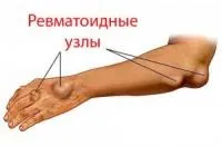 Що таке ревматоїдні вузлики причини і лікування (ревматоїдні вузли) Що таке ревматоїдні вузлики причини і лікування