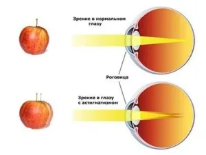 Що таке астигматизм очей у дорослих і у дитини (фото) - чим небезпечний і як при ньому бачать (дорослих) Що таке астигматизм очей у дорослих і у дитини (фото) - чим небезпечний і як при ньому бачать