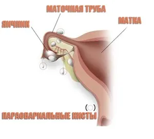 Що таке параоваріальні кісти (параоваріальні) Що таке параоваріальні кісти