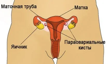 Що таке параоваріальні кісти (кісти) Що таке параоваріальні кісти