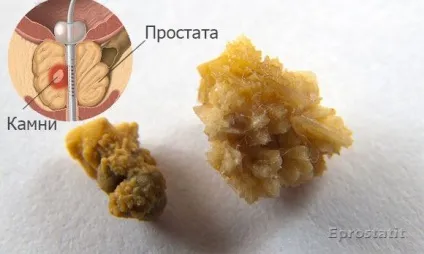 Що таке простатит у чоловіків - причини, ознаки, симптоми і лікування (чоловіків) Що таке простатит у чоловіків - причини, ознаки, симптоми і лікування