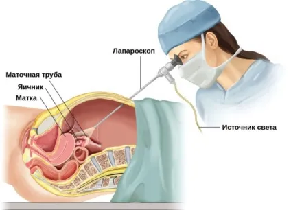 Що таке параоваріальні кісти (параоваріальні) Що таке параоваріальні кісти