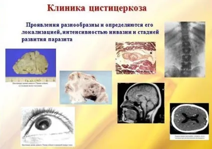 Цистицеркоз ознаки, симптоми, ускладнення (інфекційні хвороби) Цистицеркоз ознаки, симптоми, ускладнення