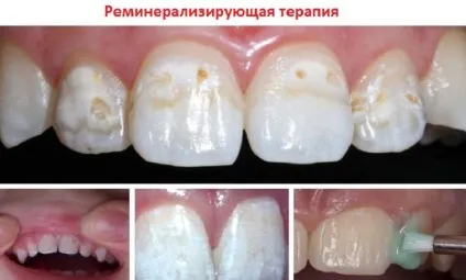 Демінералізація емалі зубів причини, симптоми, лікування і наслідки (демінералізація емалі) Демінералізація емалі зубів причини, симптоми, лікування і наслідки