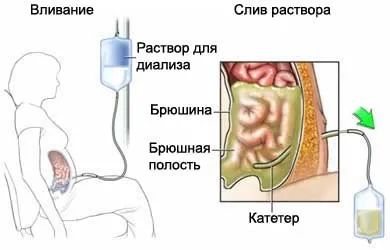 Діаліз нирок скільки живуть (живуть) Діаліз нирок скільки живуть