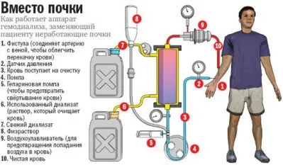 Діаліз нирок скільки живуть (живуть) Діаліз нирок скільки живуть