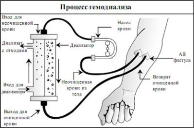 Діаліз нирок скільки живуть (скільки) Діаліз нирок скільки живуть