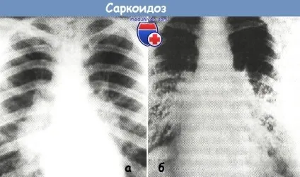 Диференціація саркоїдозу від туберкульозу