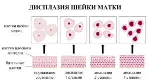 Дисплазія шийки матки особливості, причини виникнення та симптоматика (шийки) Дисплазія шийки матки особливості, причини виникнення та симптоматика