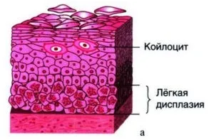 Дисплазія шийки матки особливості, причини виникнення та симптоматика (матки) Дисплазія шийки матки особливості, причини виникнення та симптоматика