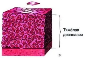 Дисплазія шийки матки особливості, причини виникнення та симптоматика (дисплазія) Дисплазія шийки матки особливості, причини виникнення та симптоматика