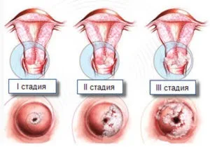 Дисплазія шийки матки особливості, причини виникнення та симптоматика (матки) Дисплазія шийки матки особливості, причини виникнення та симптоматика