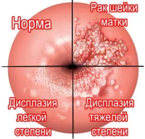 Дисплазія шийки матки особливості, причини виникнення та симптоматика (особливості) Дисплазія шийки матки особливості, причини виникнення та симптоматика